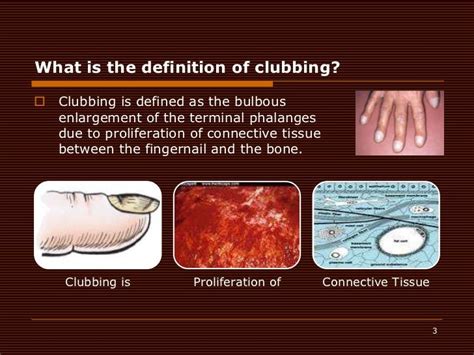 Why is clubbing expensive?